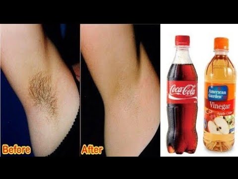 Woow! How To Remove Unwanted Hair Permanently By Using "CoCaCoLa"