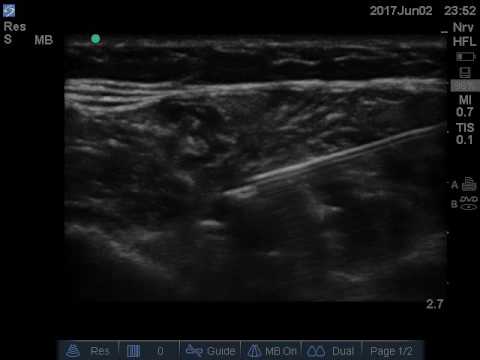 Ultrasound guided post amputation median nerve neuroma injection with immediate pain relief.