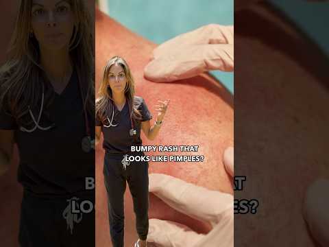 Heat Rash? 5 things to do about it #shorts #learnonyoutube #doctor