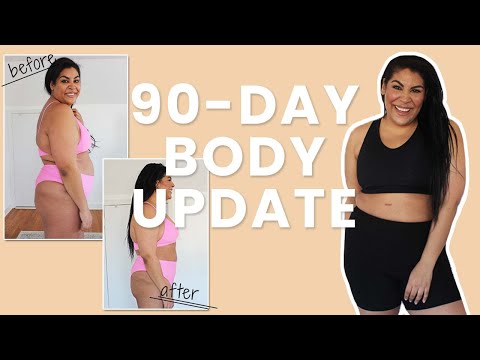 Carlene's Journey: 90-Day Liposuction Fat Loss Results & Patient Review
