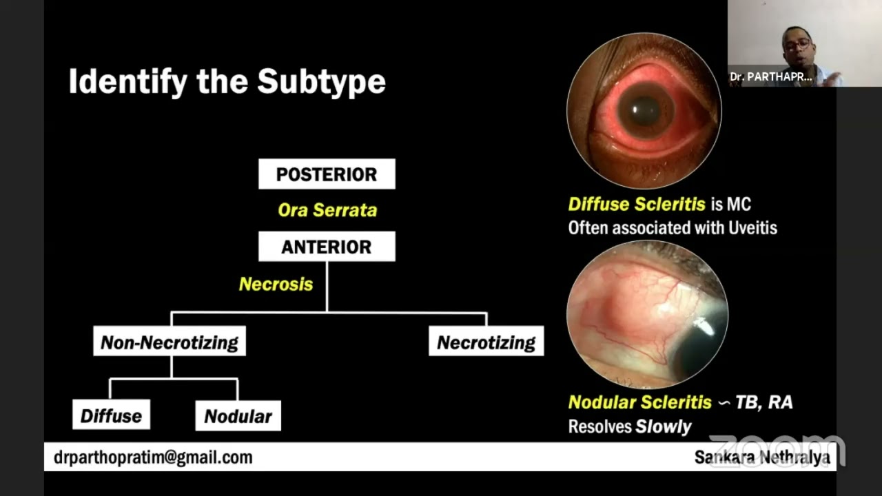 Decoding the Enigma of Scleritis