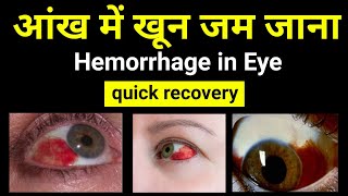 Red Spot In Eye | Subconjunctival Hemorrhage | आंख में खून जम जाना | Causes | Treatment |