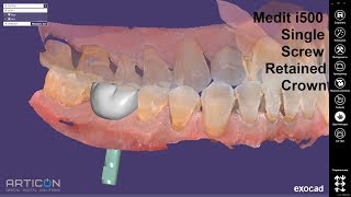 Screw Retained Crown(MEDIT i500 scan) Exocad design + Model Creator for Implant model(DIM analog)