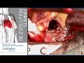 Upper Ministernotomy AVR Ross Reul MD