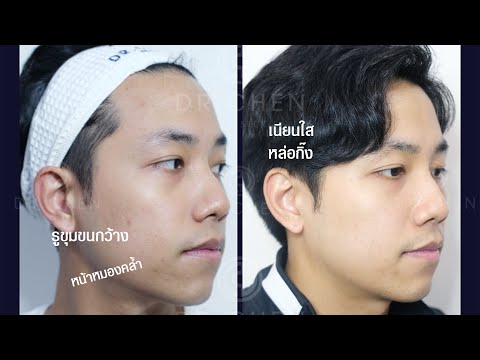 หน้าเป็นหลุมสิว แก้ไขด้วย Dr.Chen Injection (Skin Rejuvenation) หน้าเป็นหลุมสิว แก้ไขด้วย Dr.Chen Injection (Skin Rejuvenation)