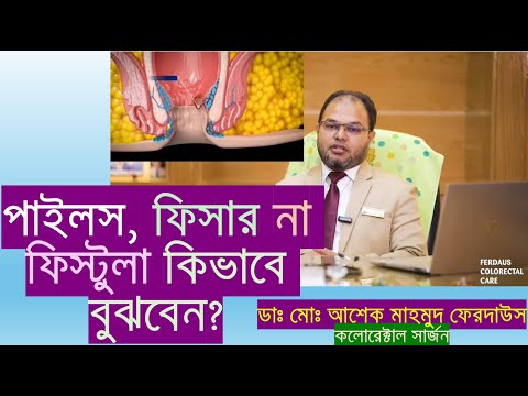 পাইলস, ফিসার নাকি ফিস্টুলা হয়েছে কিভাবে বুঝবেন?