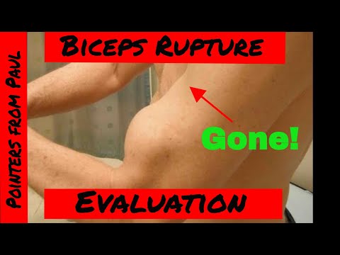 Hook Test For Distal Biceps Rupture
