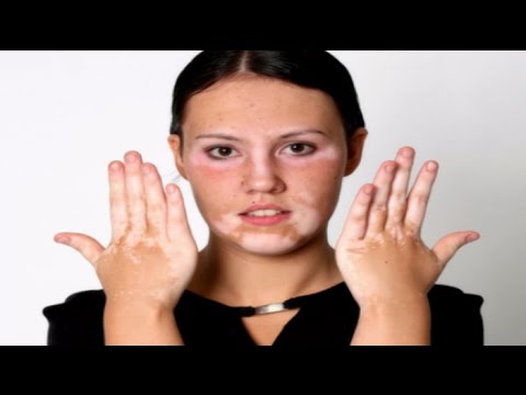 Olio da pigmentazione su una faccia I pigmentary notano a causa di una puntura
