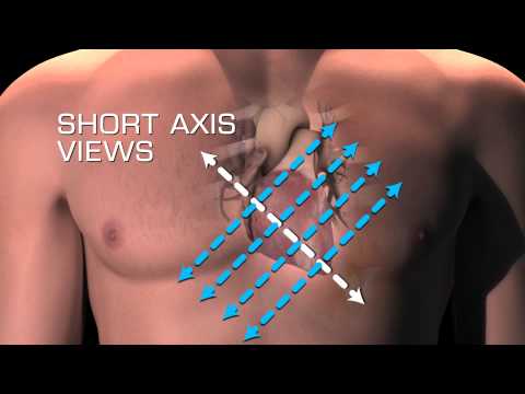 Parasternal Short Axis Views