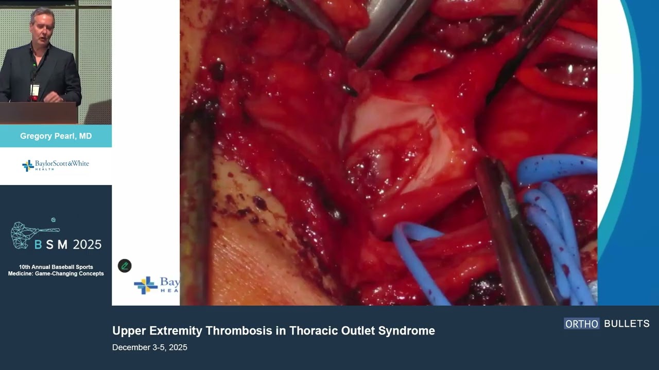 Upper Extremity Thrombosis in Thoracic Outlet Syndrome_Gregory Pearl MD