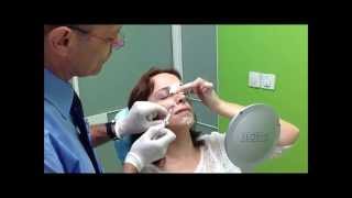 מילוי פנים באמצעות הזרקת חומצה היאלורונית