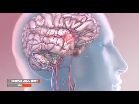 Moždani udar - simptomi, prevencija, dijagnostika