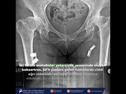 İki taraflı asetabuler yetersizlik zemininde oluşan koksartroz
