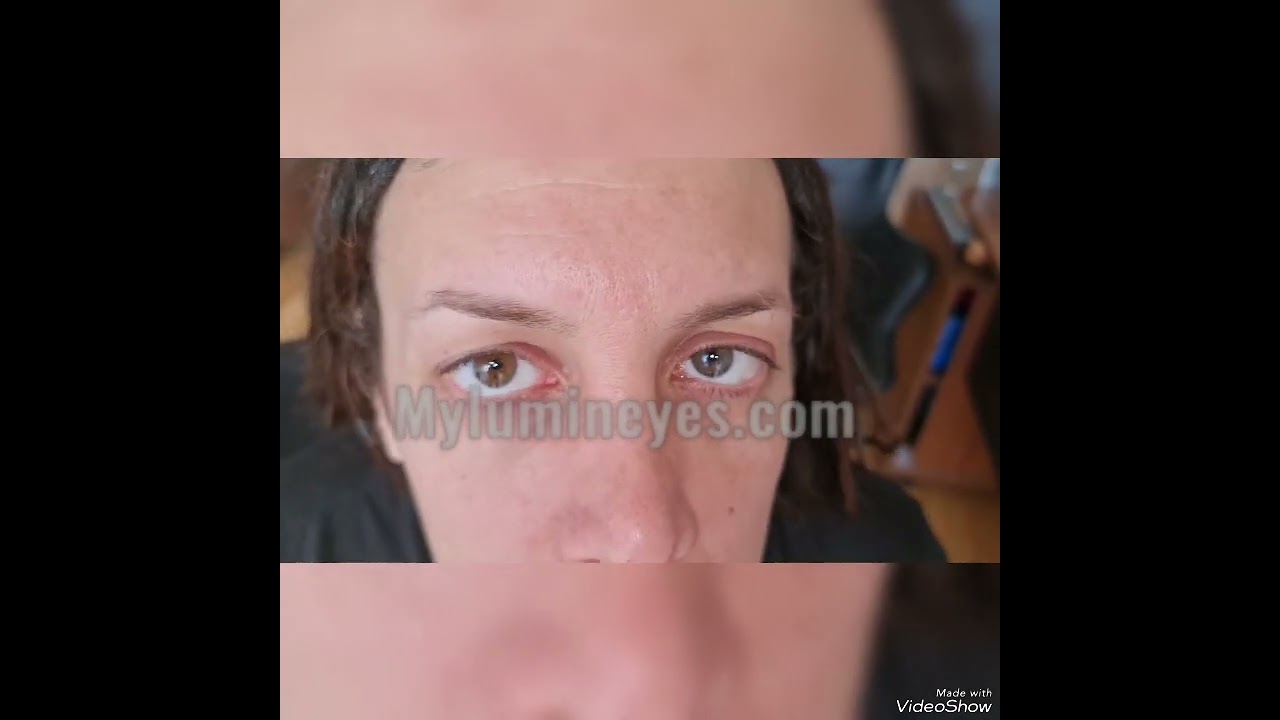 Chirurgia per il cambiamento del colore degli occhi Turchia in modo permanente