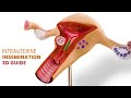 Intrauterine Insemination (IUI) for Pregnancy | Step by Step Guide | 3D Animation
