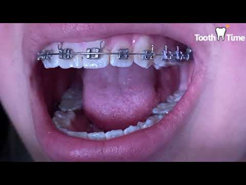 What are tongue tamers? Braces checkups - Tooth Time Family Dentistry New Braunfels