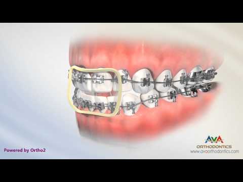 Orthodontic Treatment for Openbite - Rubber Bands
