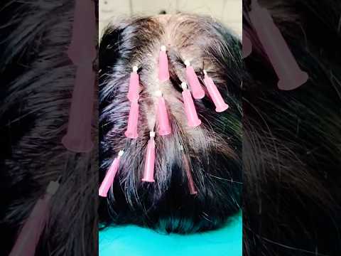 Hair fall regrowth advance Treatment