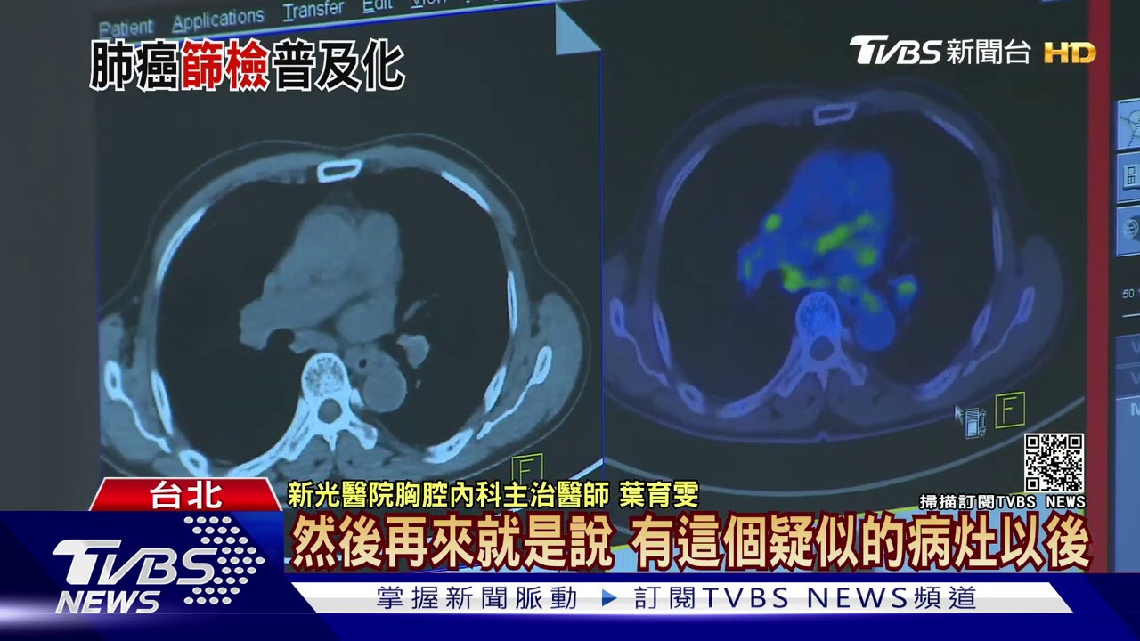 普篩?風險預測? 沉默殺手「肺癌」你不可不知