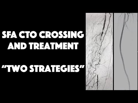 SFA CTO Crossing Technique & 2 Treatment Strategies