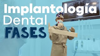 Colocación implantes dentales│Fases. Clínicas Cleardent