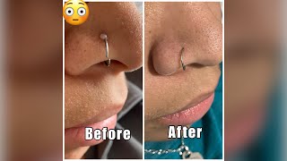 Get rid of that nose piercing bump FOR GOOD! Find out what really works! Easiest method