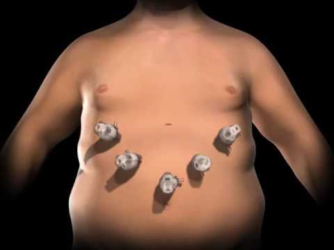 Roux-en-Y Gastric Bypass Surgery