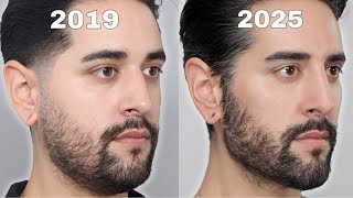 My 5 Year Journey With Botox, Fillers & Salmon DNA