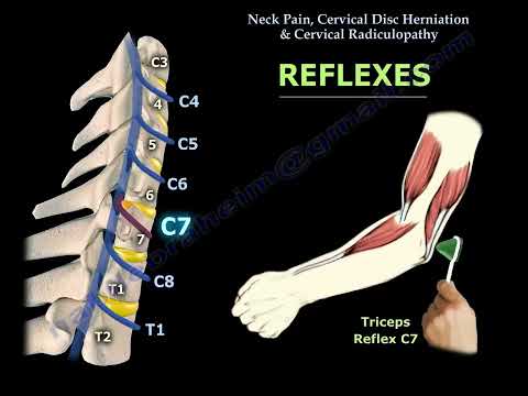 Cervical Disc Herniation: Understanding Neck Pain and Radiculopathy