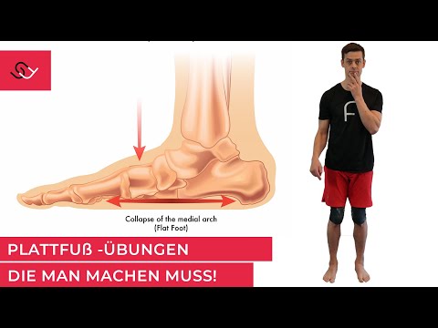 Plattfuß  - Aufbau der Fußmuskulatur oft kontraproduktiv -  Was wirklich hilft