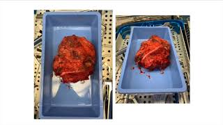 Spinal Tumors and Reconstruction - Dr. Theologis