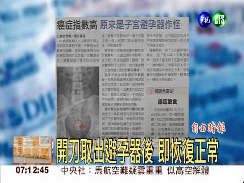 癌症指數高 原是子宮避孕器作怪