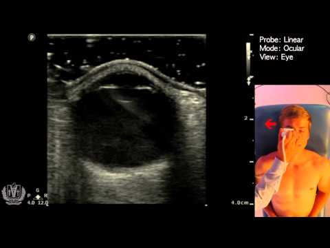 Ocular Ultrasound Basics - Made Simple