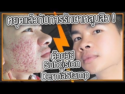 ครีมสำหรับโรคสะเก็ดเงินด้วยมือของเขาบนพื้นฐานของไขมันจากโรคสะเก็ดเงิน ครีมขี้ผึ้งราคาโรคสะเก็ดเงินมีสุขภาพดียูเครน