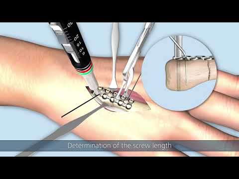 Transverse fracture of  4th metacarpal| 4th metacarpal fracture #3danimation  #animation