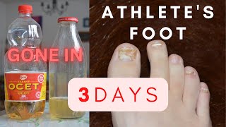 ATHLETE'S FOOT & TOE NAIL FUNGUS - HOW I HEALED IT