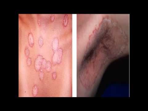 La pitiriasis versicolor y otras enfermedades de la piel y uñas