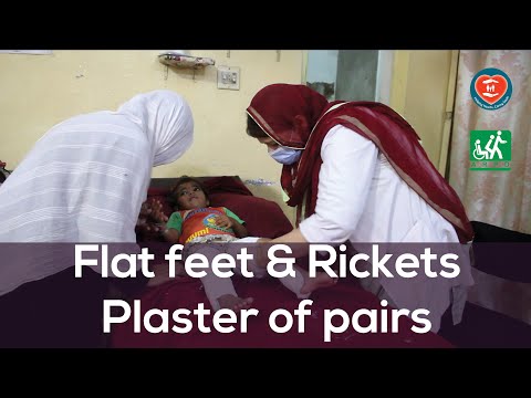 Flat feet & Rickets | Plaster of pairs | HHCS & ARPD