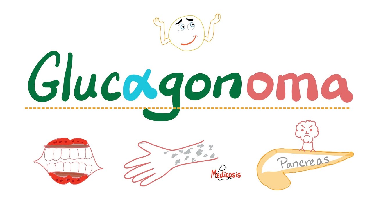 Glucagonoma - Pancreatic Neuroendocrine Tumors - Islet Cell Tumors - Biochemistry & Pathology