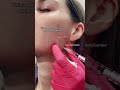 Masseter Botox | Facial Plastic Surgeon in Beverly Hills, CA #shorts