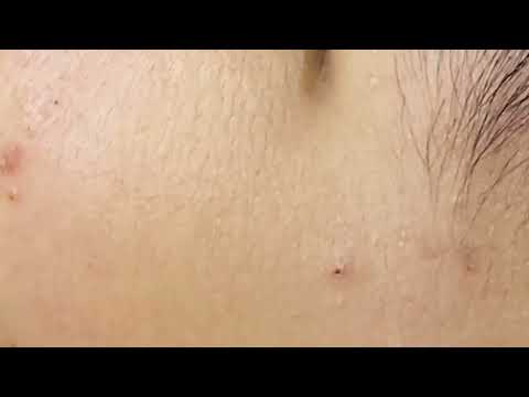 CRAZY BLACKHEAD REMOVAL – I Didnt Know This Was Possible