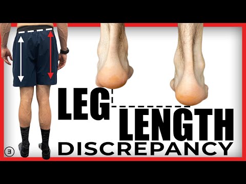 Leg Length Discrepancy (Why It Probably Doesn't Matter | Evidence Based)