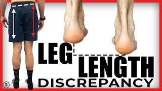 Leg Length Discrepancy (Why It Probably Doesn