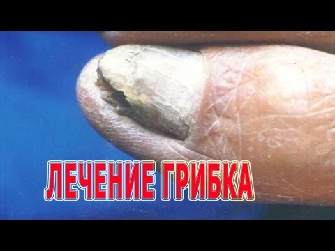 Die Behandlung gribka der Nägel die ergebnisreichsten Präparate Das billigste Mittel von gribka auf der Haut