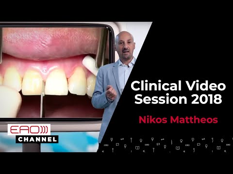 Immediate implants with guided surgery