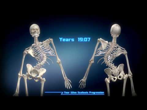 Osteoparoz e mal di schiena Rimedi popolari contro osteocondrosi