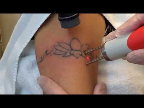 Dr. Robert Burke: Tattoo Removal With The Quanta Q-Plus C
