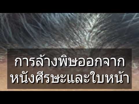 Neurodermatitis และโคลน การรักษาฮอร์โมนสำหรับโรคสะเก็ดเงิน