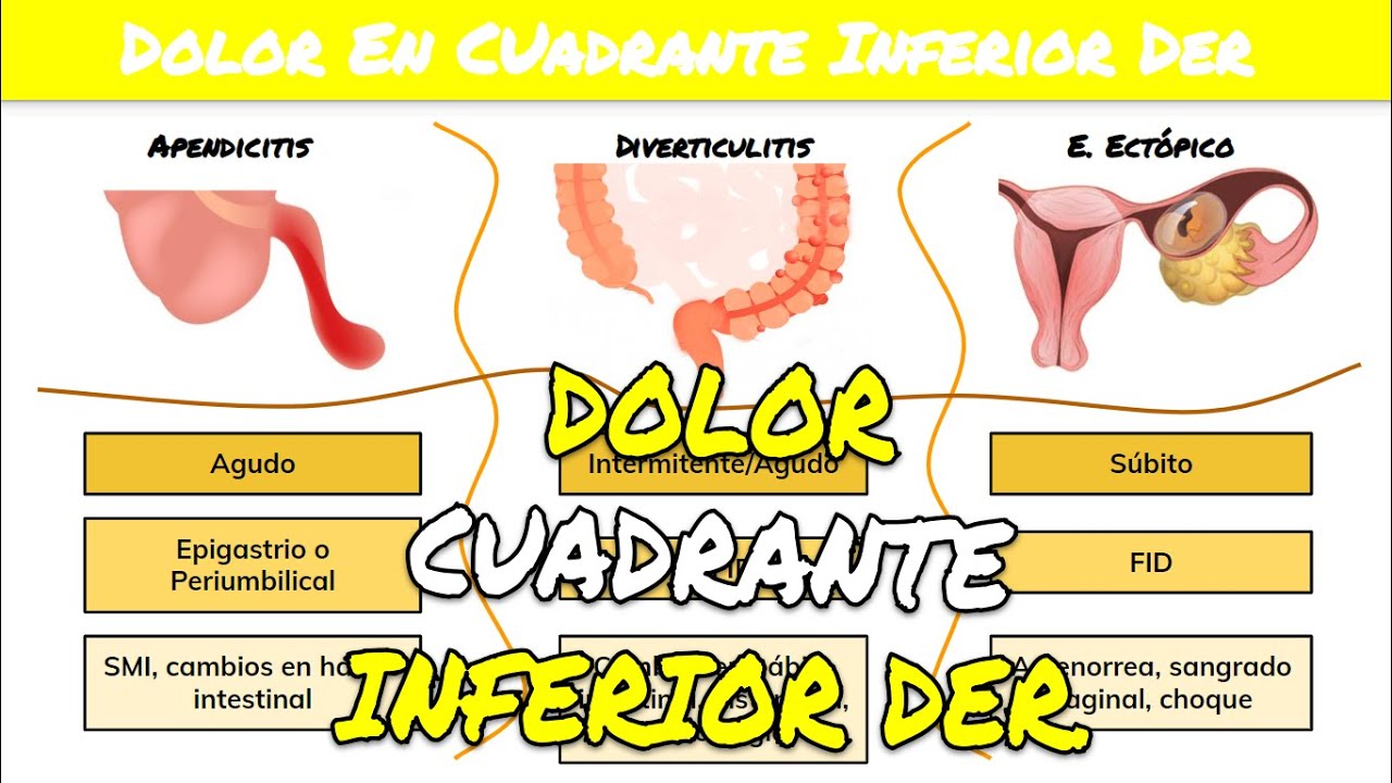 Watch ⚕️🩺 DOLOR EN LADO DERECHO DEL ABDOMEN - Apendicitis o Diverticulitis o Embarazo Ectópico Now ⚕️🩺 DOLOR EN LADO DERECHO DEL ABDOMEN - Apendicitis o Diverticulitis o Embarazo Ectópico
