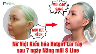 HOT NHẤT hôm nay: Nữ Việt kiều Mỹ sau Nâng mũi S Line 7 ngày hoá HOTGIRL LAI TÂY